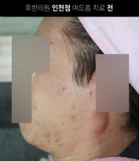 치료 전