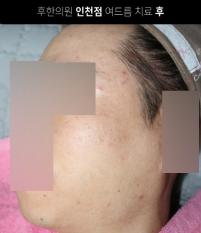 치료 후