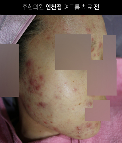 치료 전