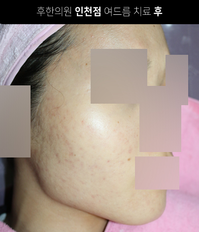 치료 후