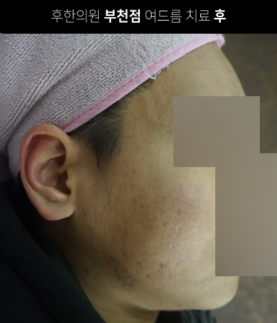 치료 후
