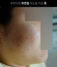 치료 후