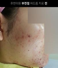 치료 전