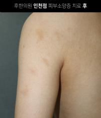 치료 후