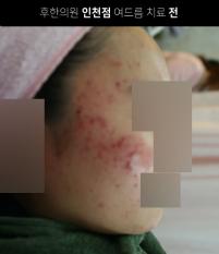 치료 전