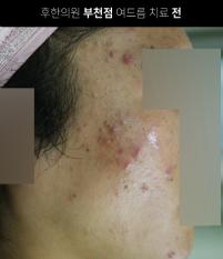 치료 전