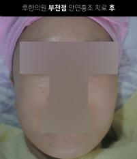 치료 후