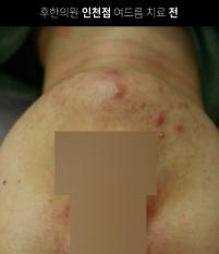 치료 전