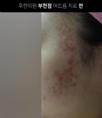 치료 전