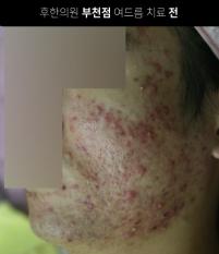 치료 전