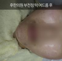 치료 후