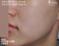 치료 후