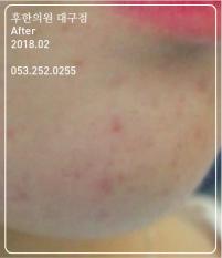 치료 후