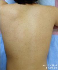 치료 후