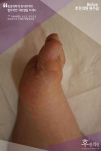 치료 전