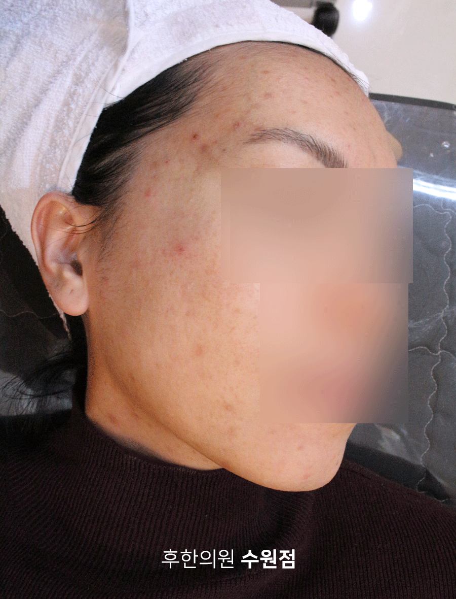 치료 후