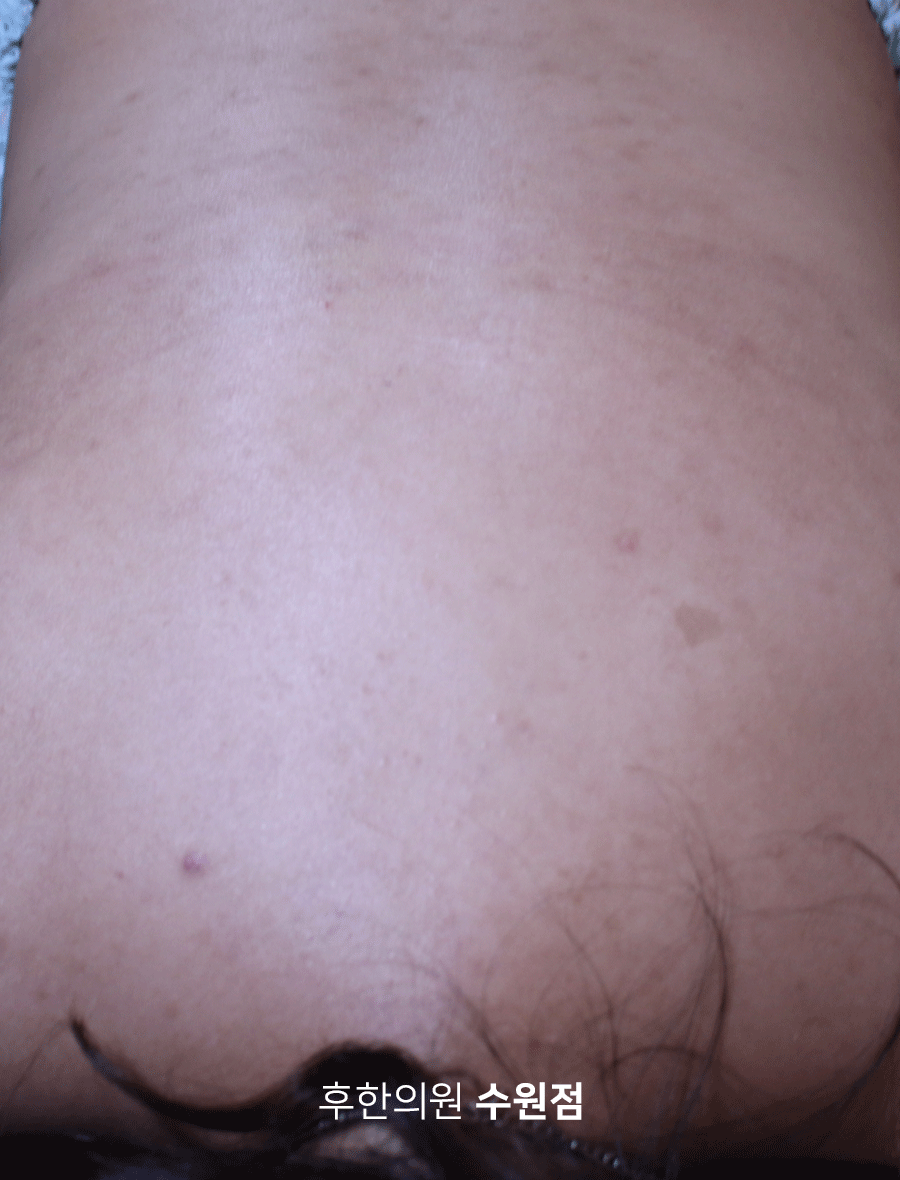 치료 후