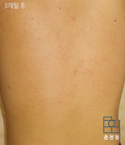 치료 후