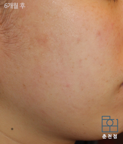 치료 후
