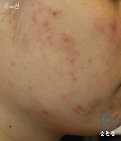 치료 전
