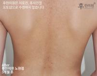 치료 후
