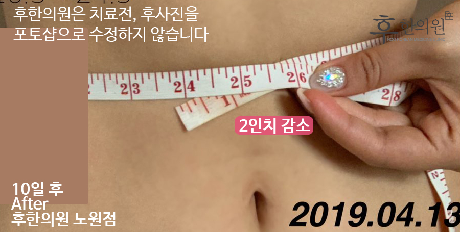 치료 후