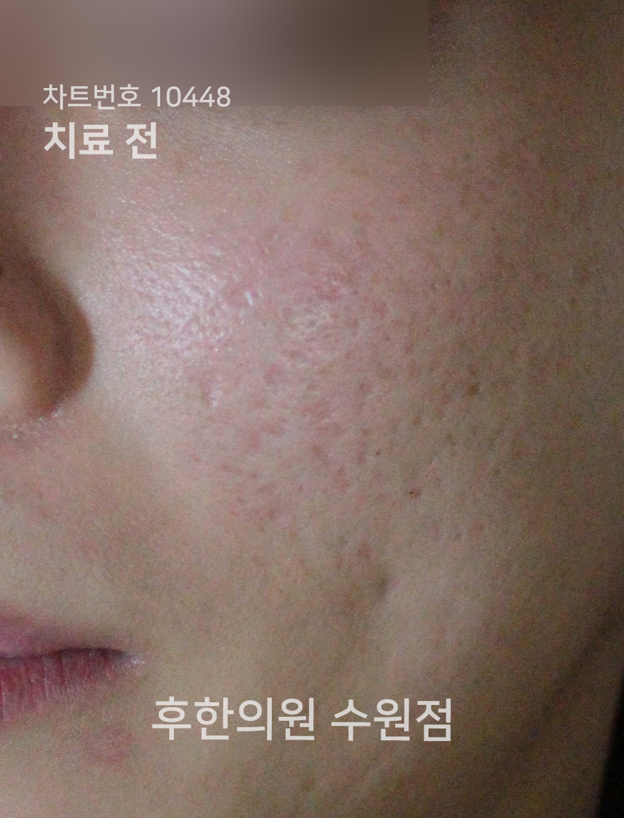 치료 전