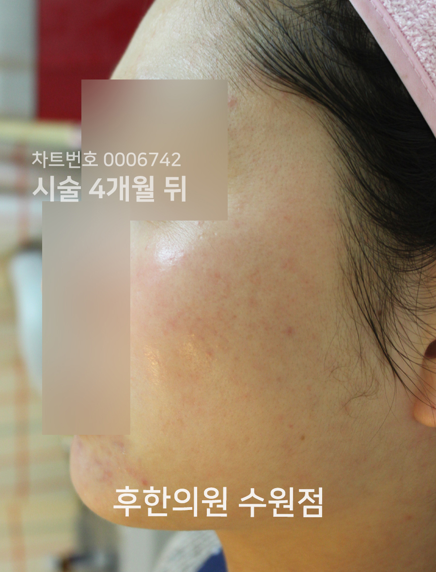 치료 후