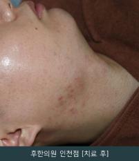 치료 후