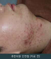 치료 전