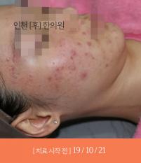 치료 전