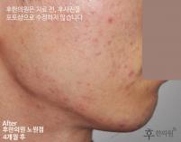 치료 후
