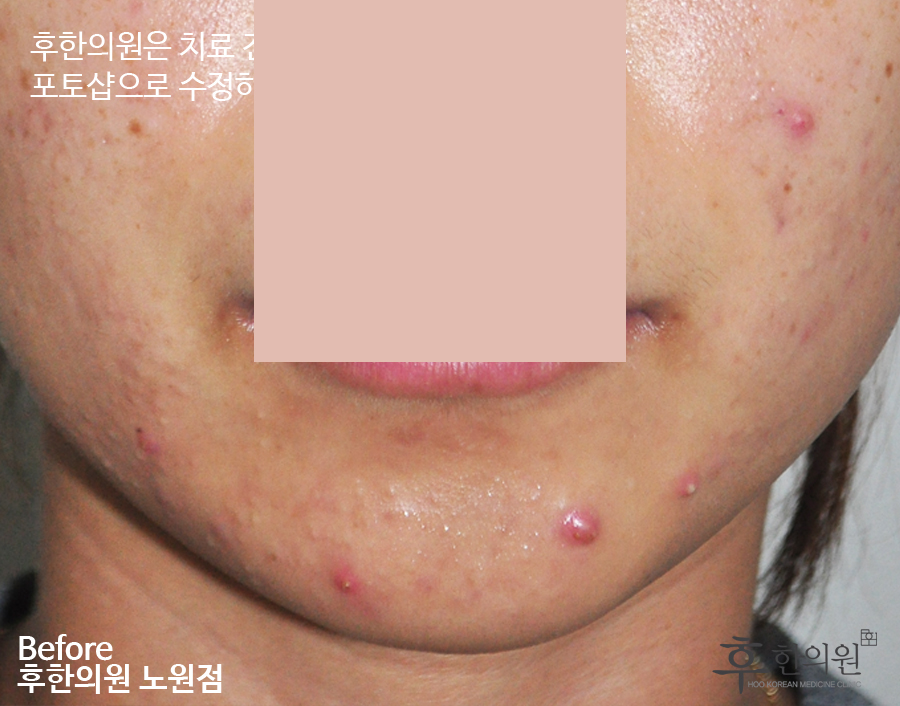 치료 전