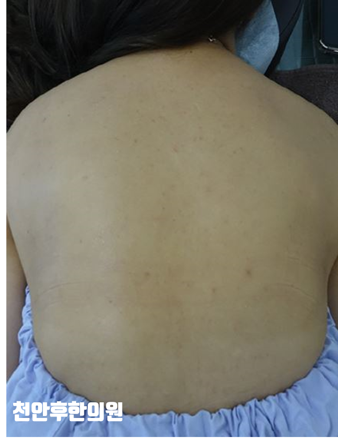 치료 후
