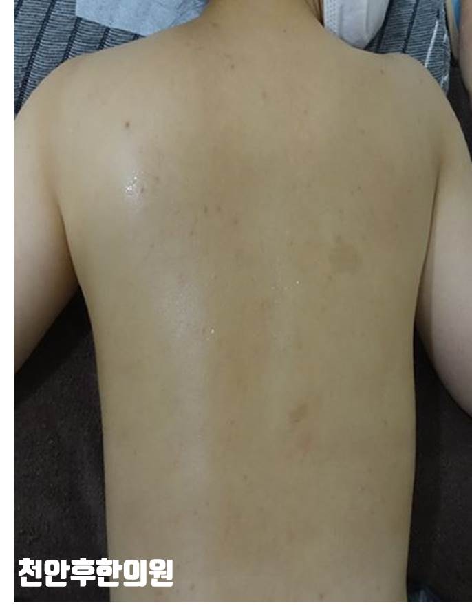 치료 후