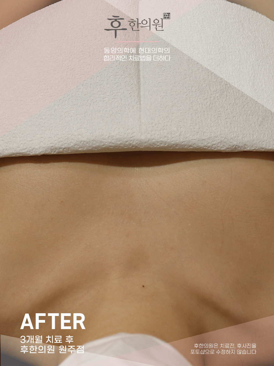 치료 후