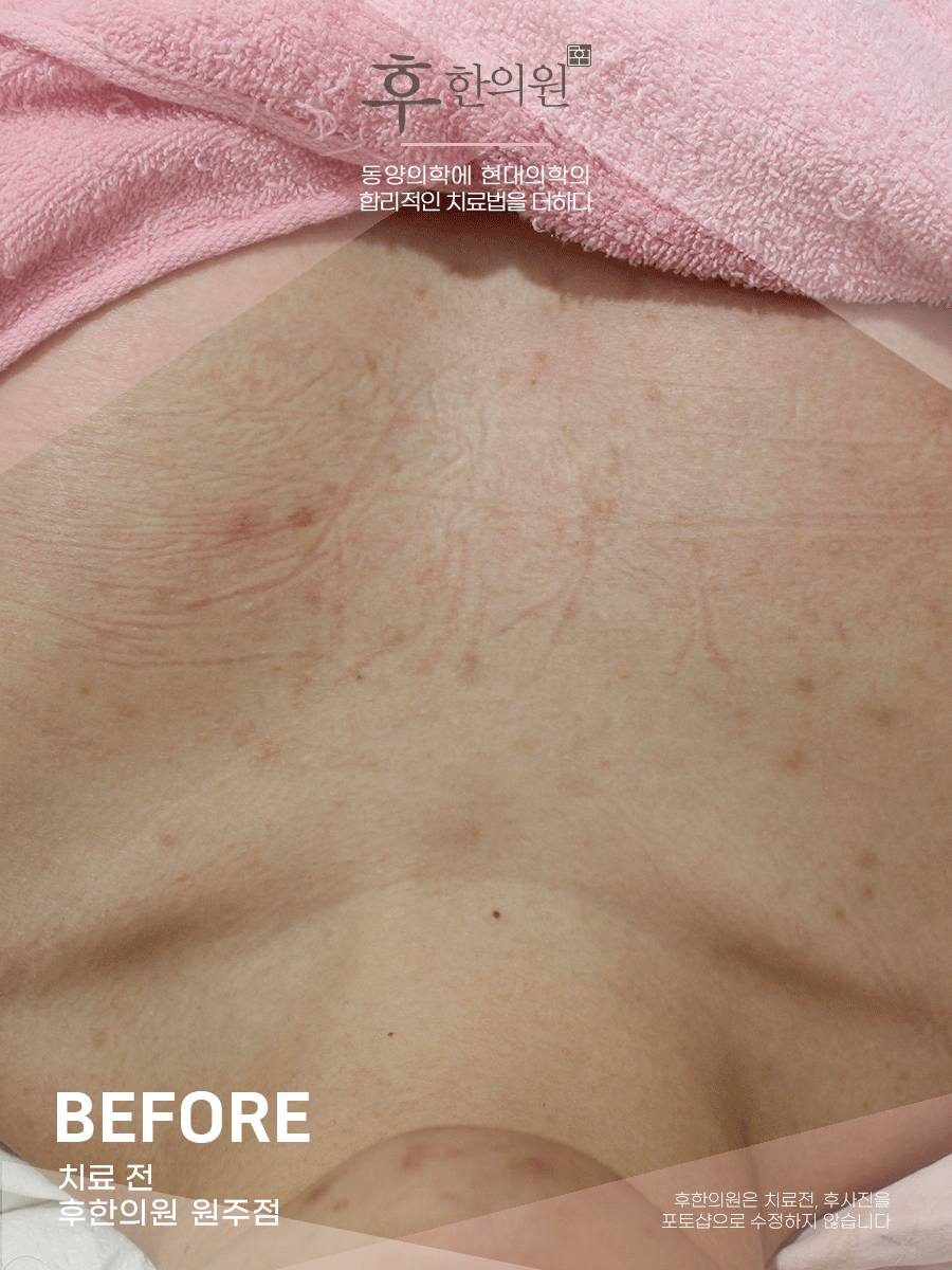 치료 전
