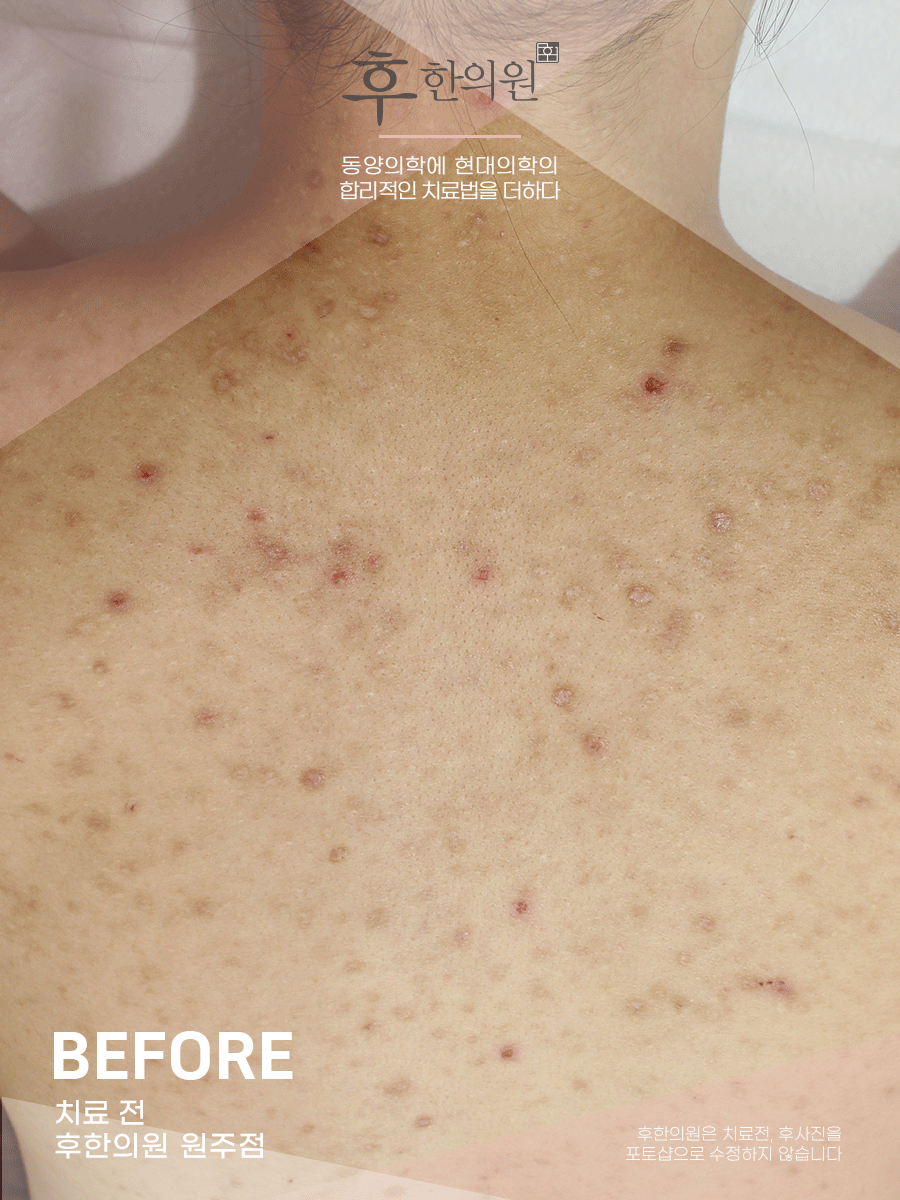 치료 전