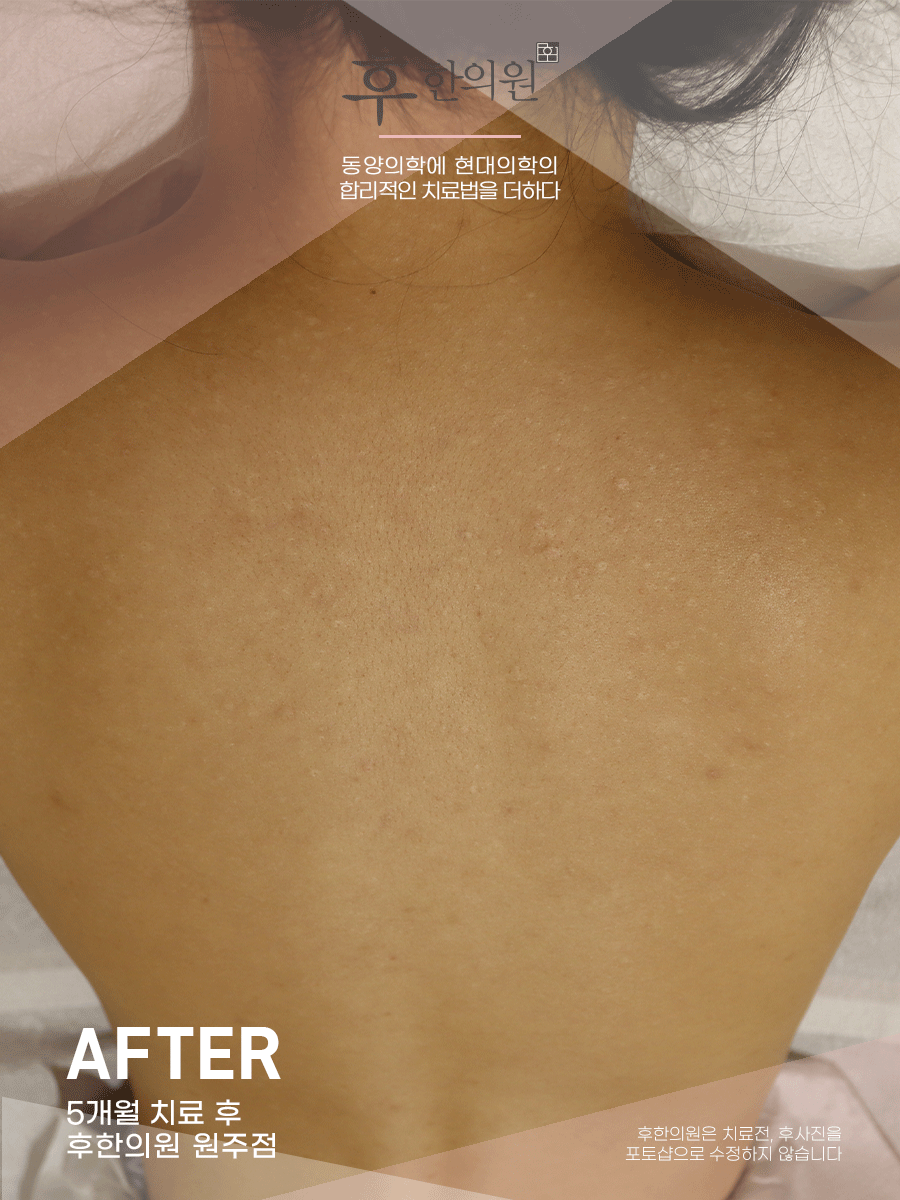 치료 후