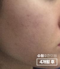 치료 후