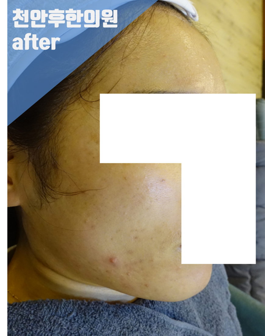 치료 후