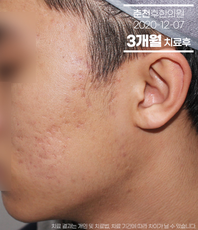 치료 후