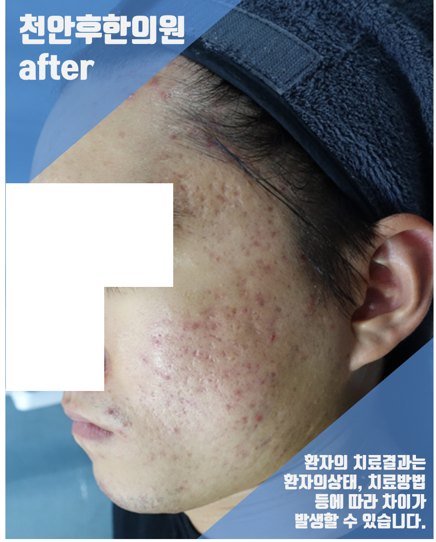 치료 후