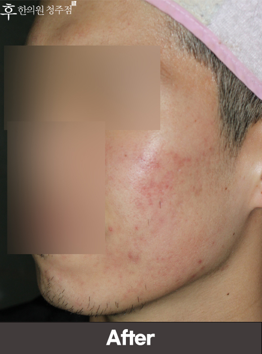 치료 후