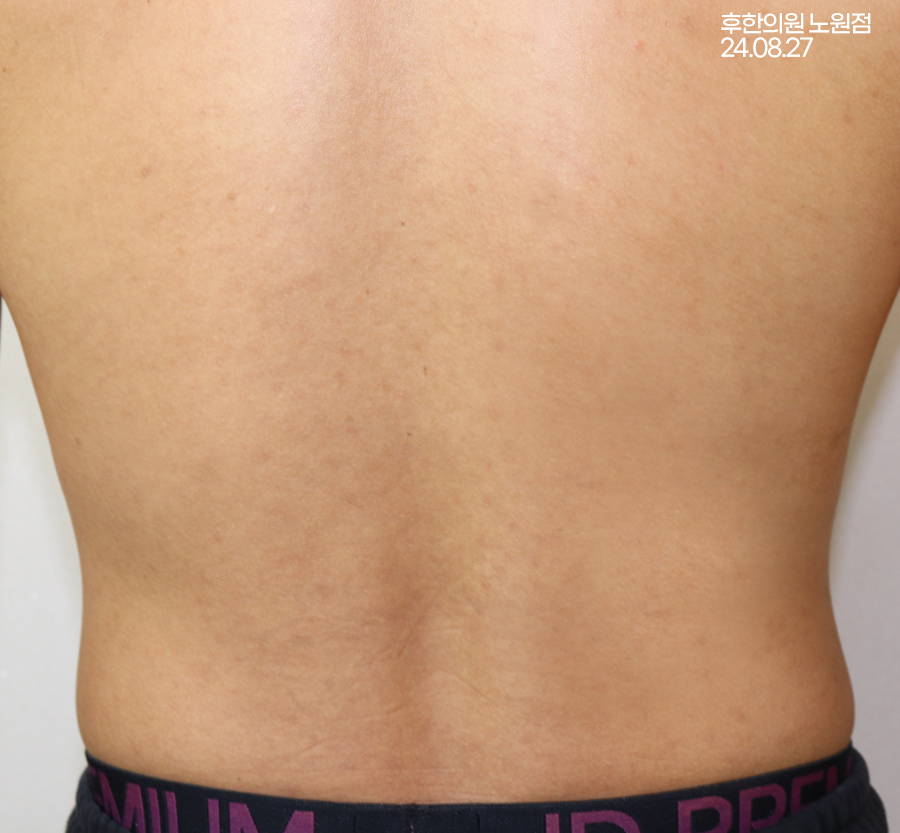 치료 후